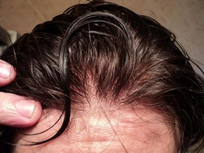 protesi capelli vantaggi e svantaggi