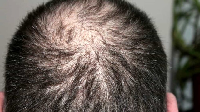 L’impatto devastante del covid-19 sulla caduta dei capelli