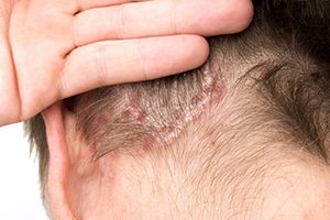 Infezioni del cuoio capelluto: cause, segni e trattamento