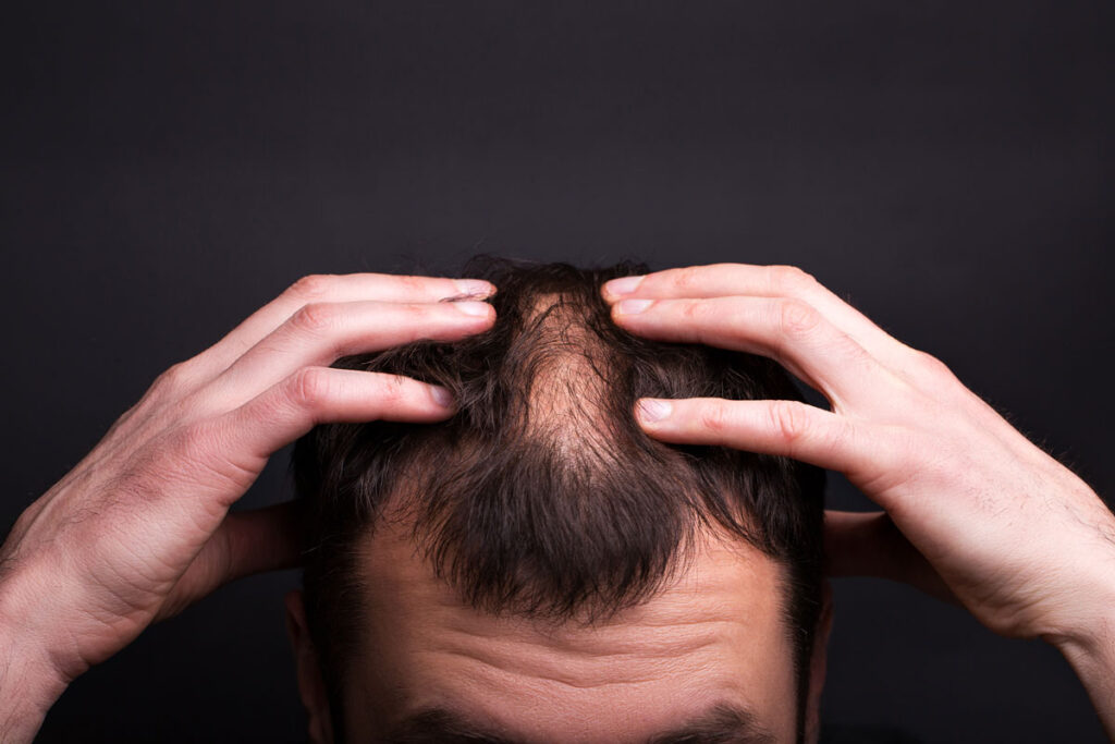 9 cause di perdita di capelli e di calvizie negli uomini
