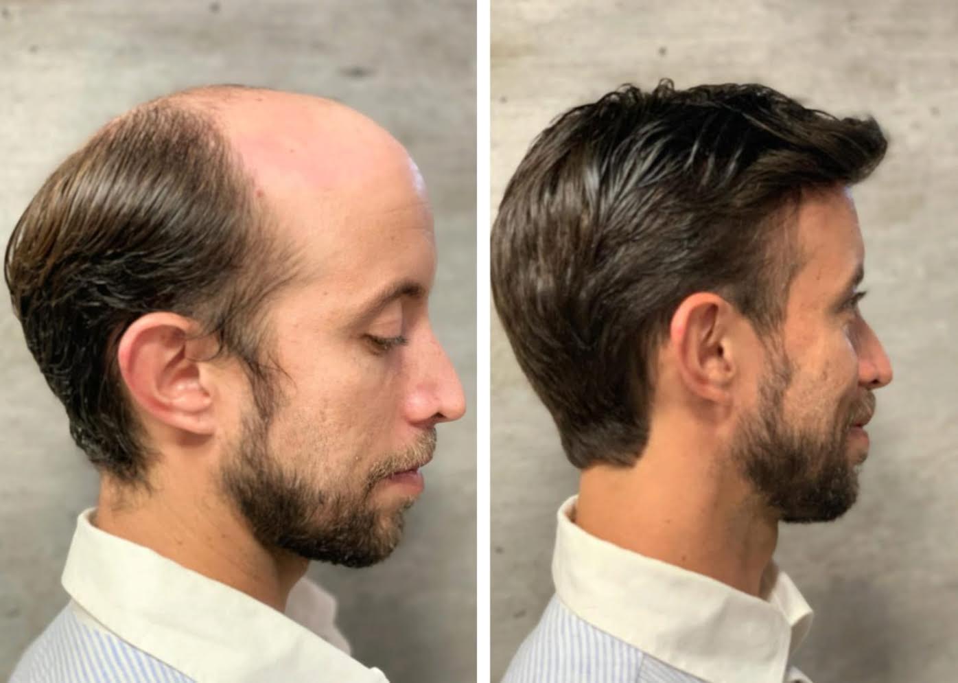 Perdita Dei Capelli E Ormoni - Microbiologia Italia - Foto 11