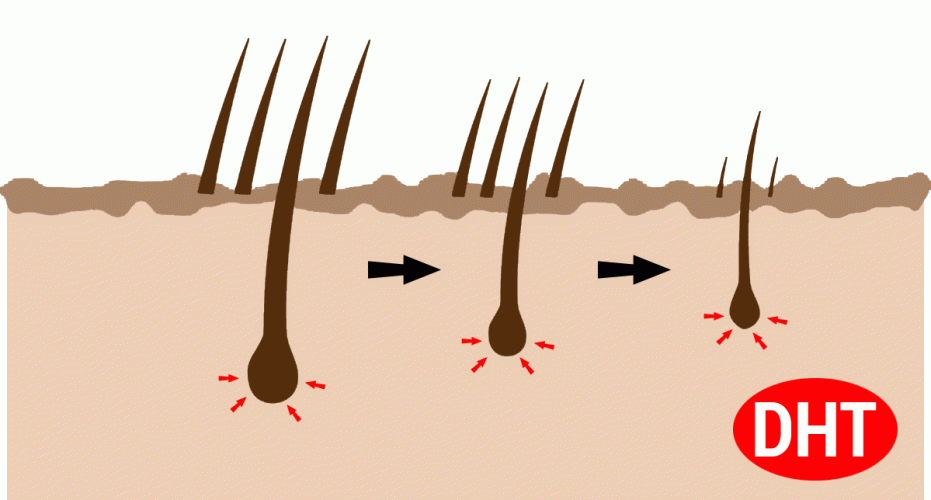 Tutto quello che devi sapere sul DHT e sulla caduta dei capelli