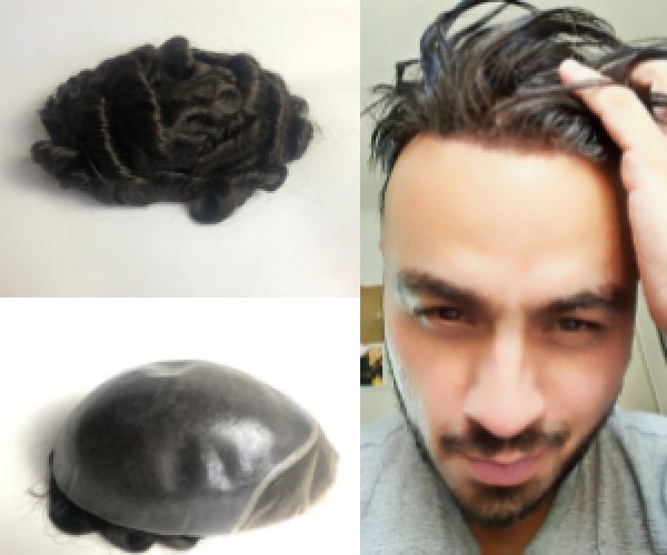 cosa sai della patch cutanea o della protesi per capelli?