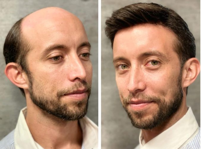 patch cutanea vs trapianto capelli