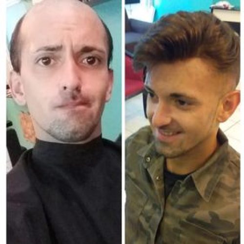 Blog protesi capillari