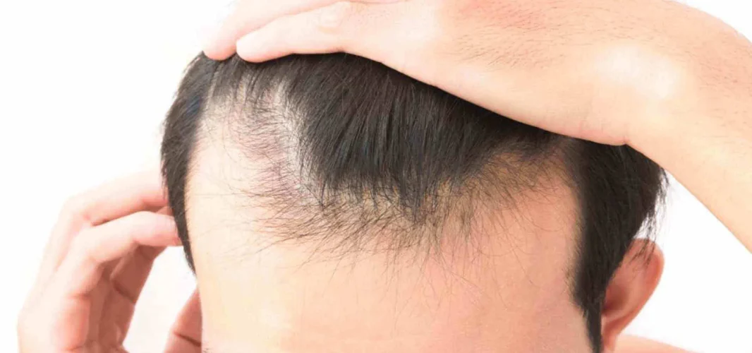 caduta-capelli-2