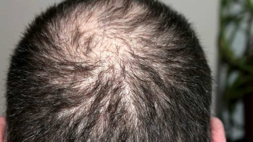 L’impatto devastante del covid-19 sulla caduta dei capelli