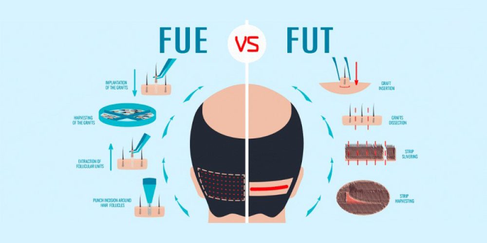 Trapianto di capelli FUE vs FUT: Quale chirurgia di trapianto è la migliore?