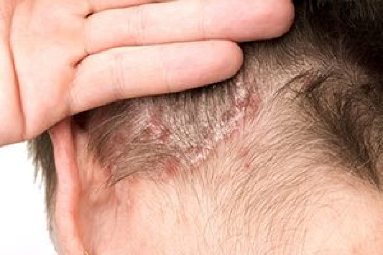 Infezioni del cuoio capelluto: cause, segni e trattamento