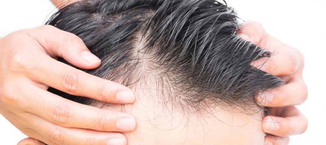 Prevenire e fermare la caduta dei capelli sotto i 25 anni