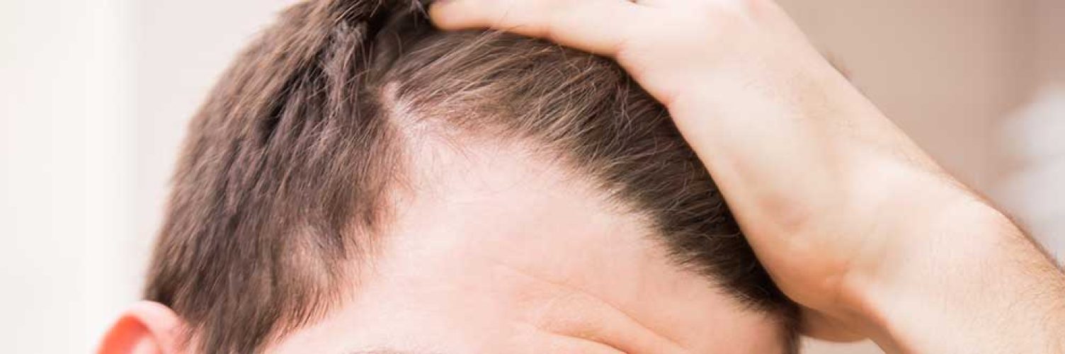 diradamento dei capelli