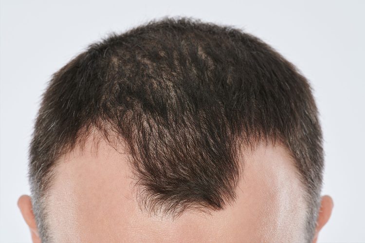 Stempiatura, modi per sconfiggere il tuo peggior nemico: l'attaccatura dei capelli sfuggente