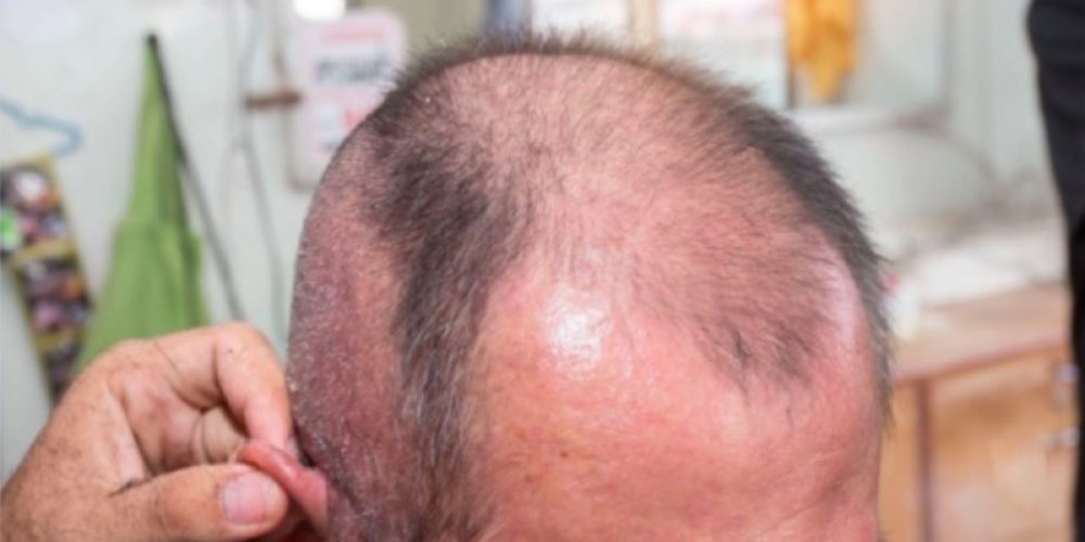 Comprendere le Condizioni Mediche che Causano la Caduta dei Capelli